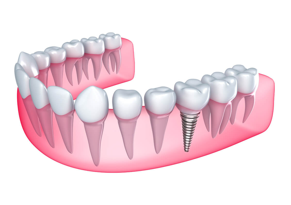 Implants vs dentures
