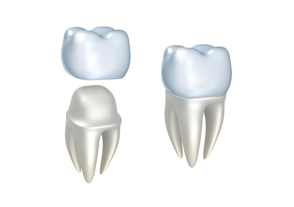 Crown vs. Filling: What's the Difference?