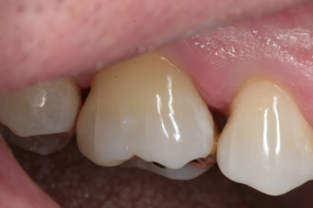 Image of tooth with gold casting and cheek retracted