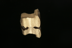 Cast gold restoration prior to cementation onto tooth